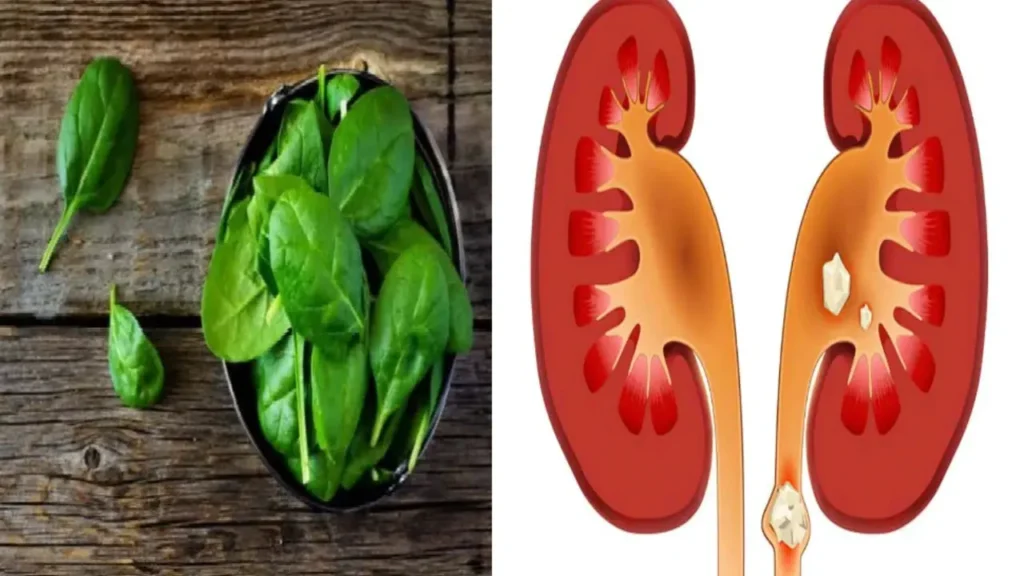 These seven vegetables cause kidney stones