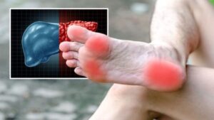 If the soles of the feet are constantly hot, it can be a sign of liver damage!