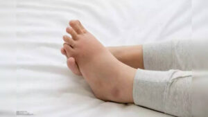 If you complain of constant swelling in your legs, your kidneys are in the danger zone!