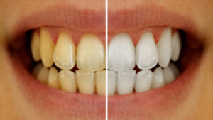 Brighten yellow teeth with betel ash: gum problems will also be removed